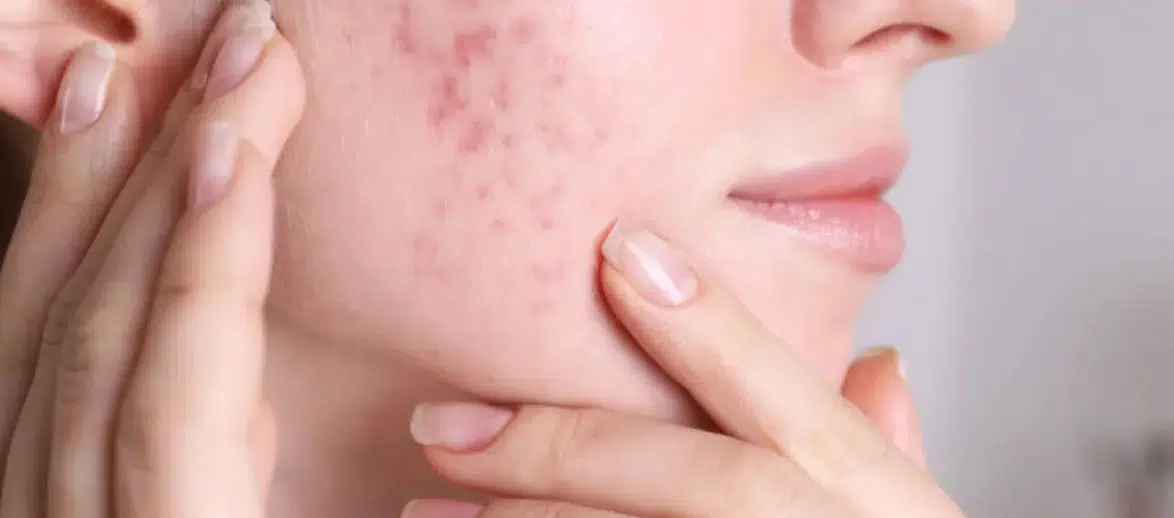 Sivilce İzlerinden Kurtulmak Mümkün! İşte Evde Uygulanabilir Doğal Tarifler