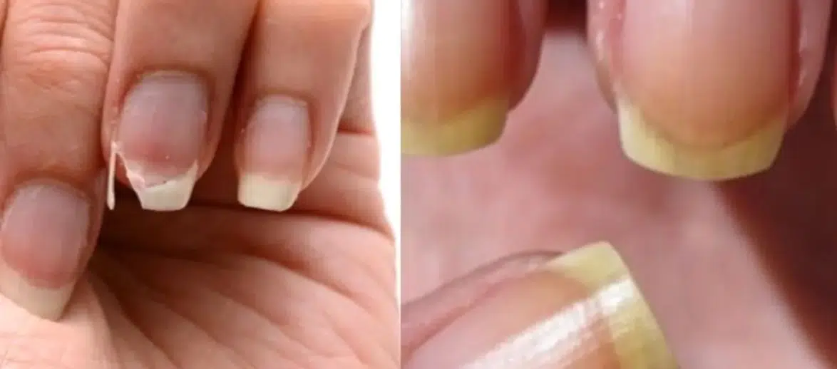 Kırılan, sararan, uzamayan tırnaklara doğal çözüm! Sirke ve limon mucizesi