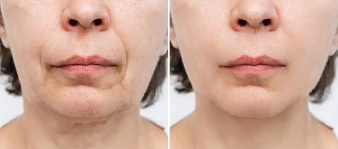 Şekerin Beslenmeden Çıkarılması Cilt Sağlığını Nasıl Etkiliyor?