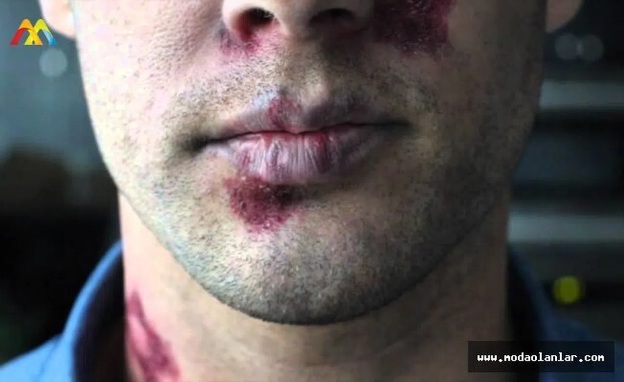 AIDS Cinsel Yolla Nasıl Geçiyor? AIDS Tedavisi Nedir?