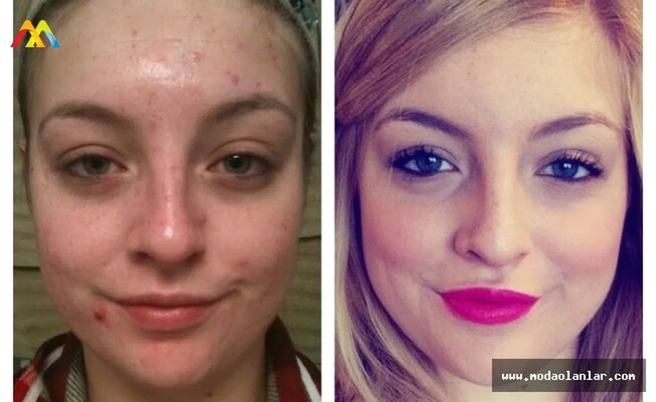 Zoretanin ve Roaccutane Arasında Fark Var Mı?