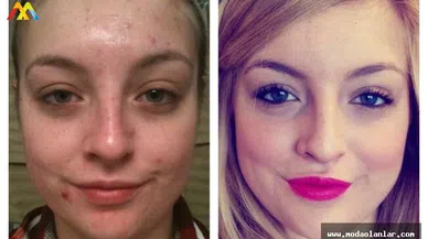 Zoretanin ve Roaccutane Arasında Fark Var Mı?