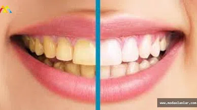 Dişlerinizin Sararmasına Doğal Çözüm