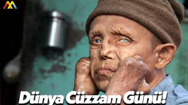 Dünya Cüzzam Günü!