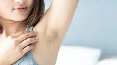 Koltuk Altı Kararmalarına Doğal Çözüm! 4 Malzemeli Tarifle Cildiniz Pamuk Gibi Olsun