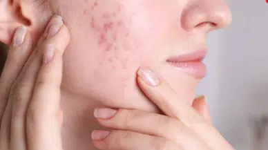 Sivilce İzlerinden Kurtulmak Mümkün! İşte Evde Uygulanabilir Doğal Tarifler