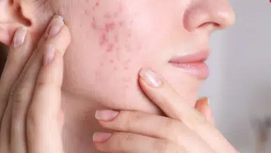 Sivilce İzlerinden Kurtulmak Mümkün! İşte Evde Uygulanabilir Doğal Tarifler