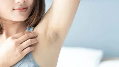 Koltuk Altı Kararmalarına Doğal Çözüm! 4 Malzemeli Tarifle Cildiniz Pamuk Gibi Olsun