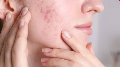 Sivilce İzlerinden Kurtulmak Mümkün! İşte Evde Uygulanabilir Doğal Tarifler