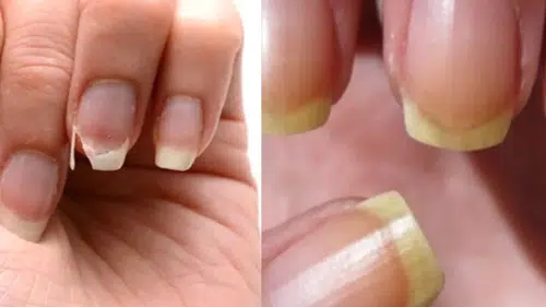 Kırılan, sararan, uzamayan tırnaklara doğal çözüm! Sirke ve limon mucizesi