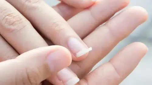 Tırnaklarınız güçsüz mü? İşte en etkili doğal ve eczane destekli yöntemler
