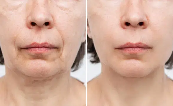 Şekerin Beslenmeden Çıkarılması Cilt Sağlığını Nasıl Etkiliyor?