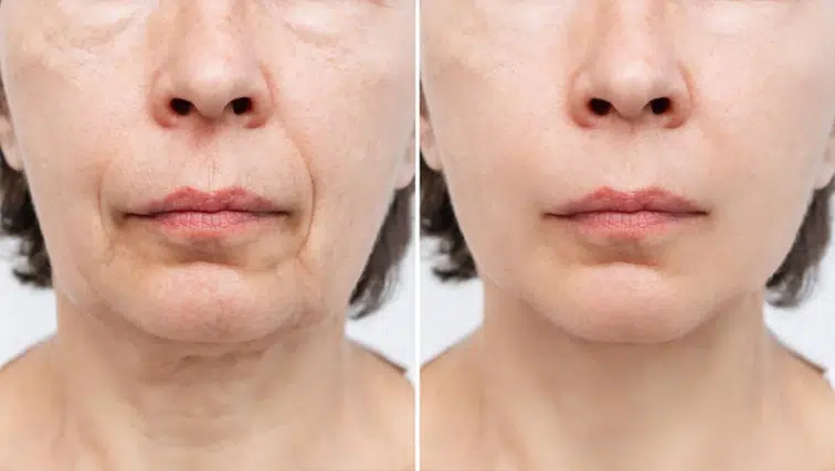 Şekerin Beslenmeden Çıkarılması Cilt Sağlığını Nasıl Etkiliyor?